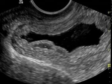 Ultrasound shows chronic cystitis