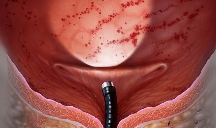 cystitis