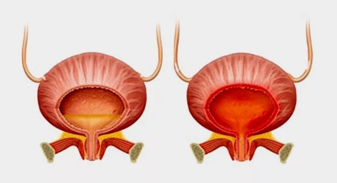 Normal bladder (left) and cystitis bladder (right)